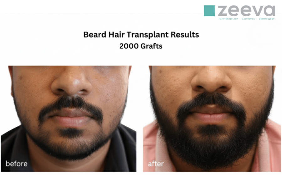Beard Transplant hero