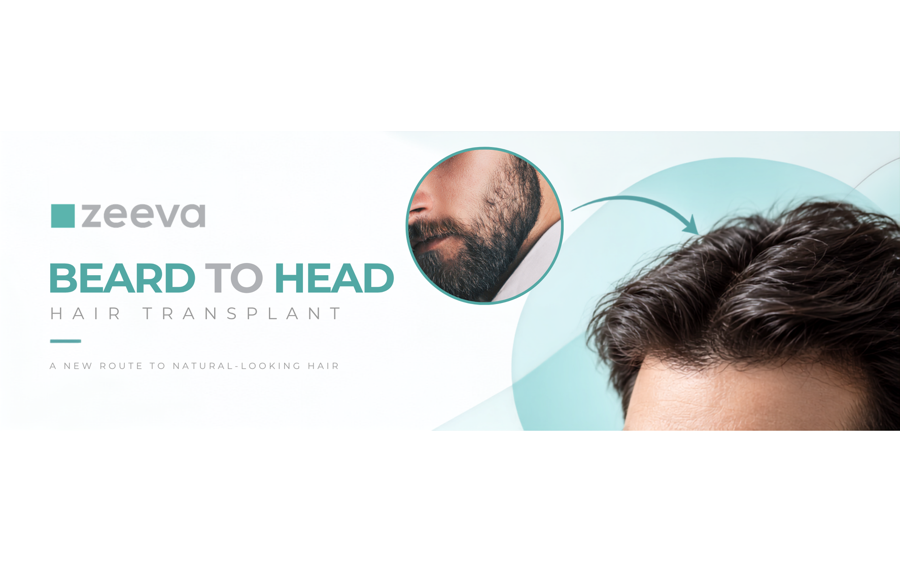 Beard to head hair transplant at Zeeva Clinic