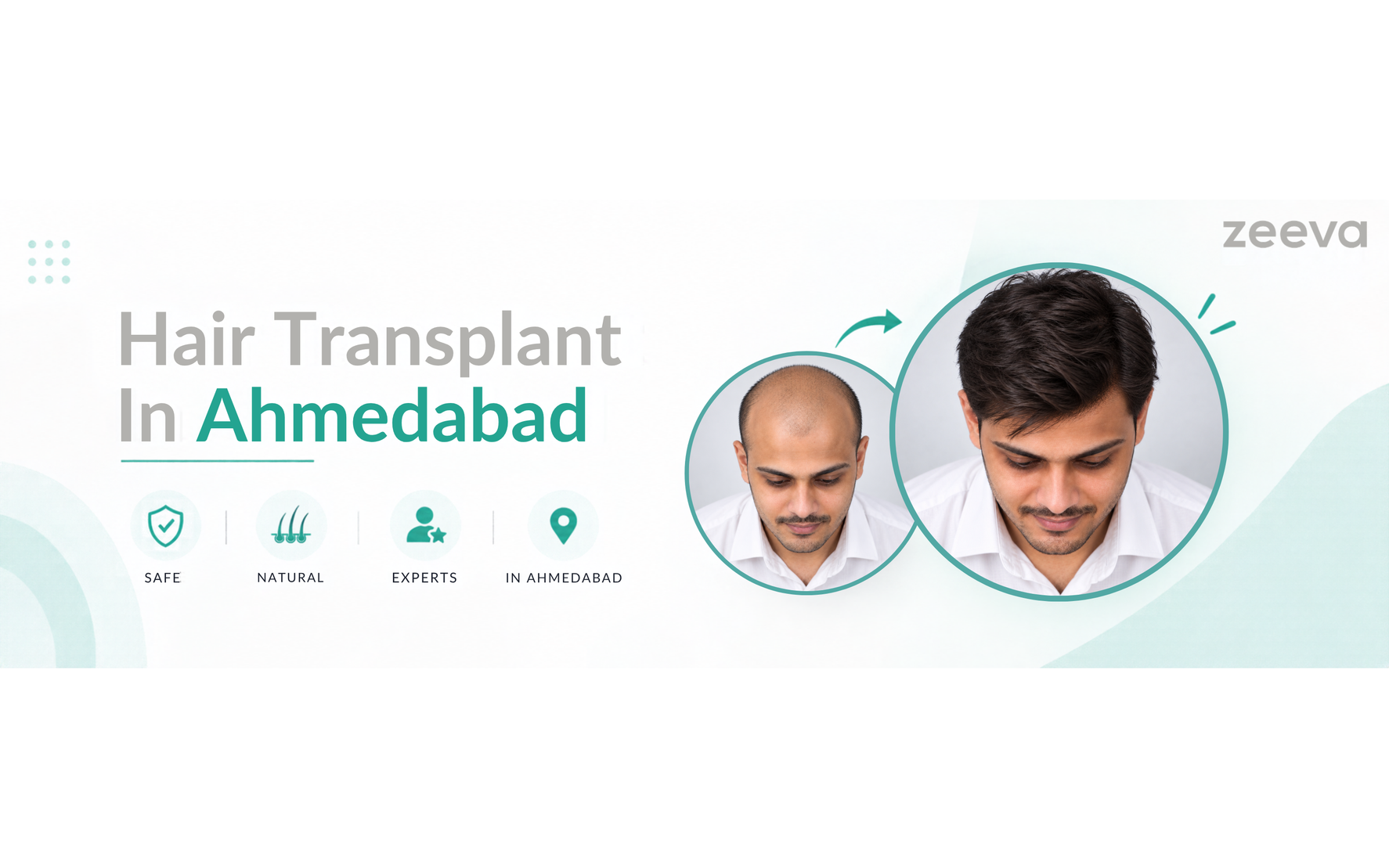 Choosing a hair transplant clinic in Ahmedabad