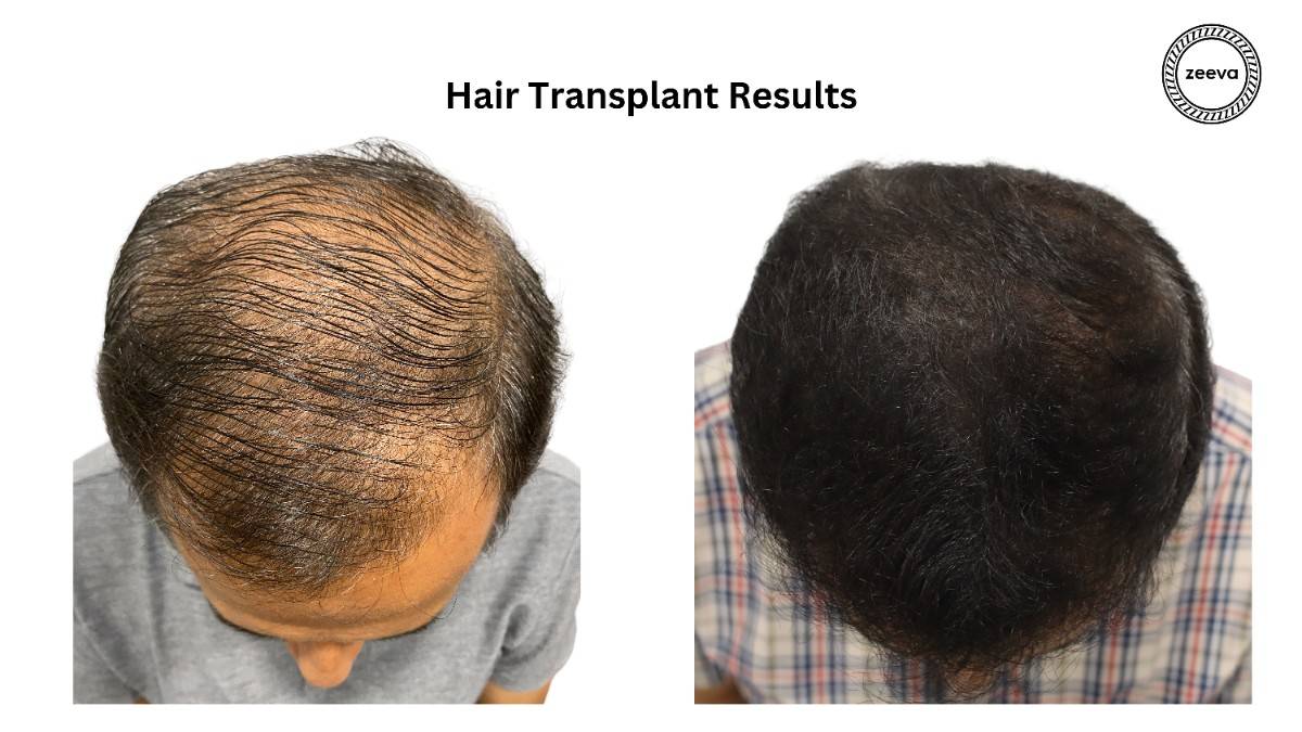 High density hair transplant result
