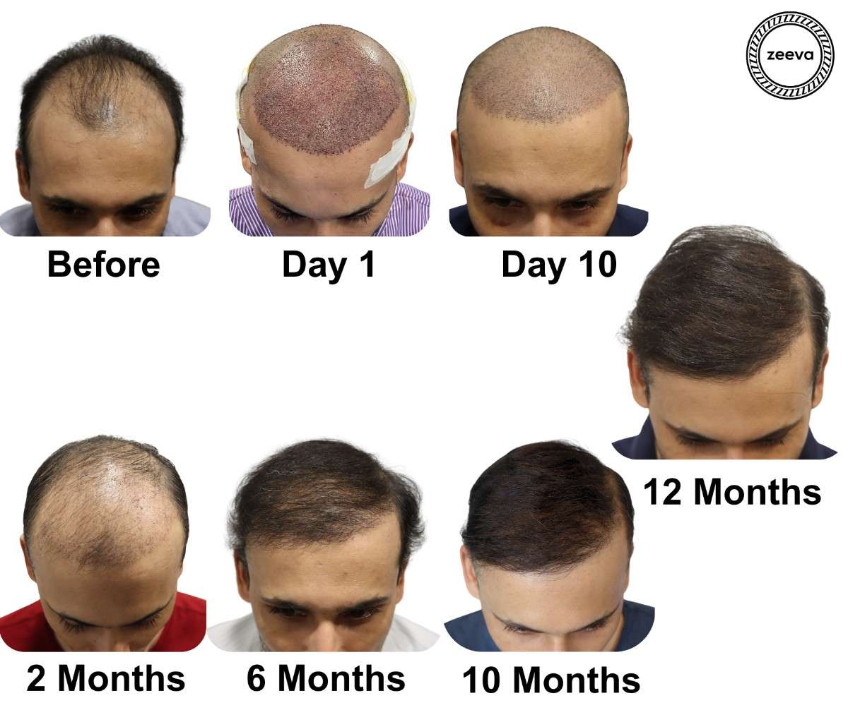 High density hair transplant result