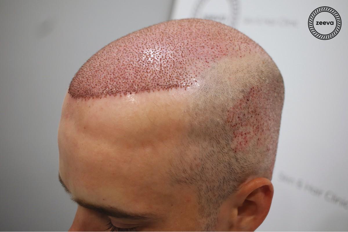High density hair transplant result