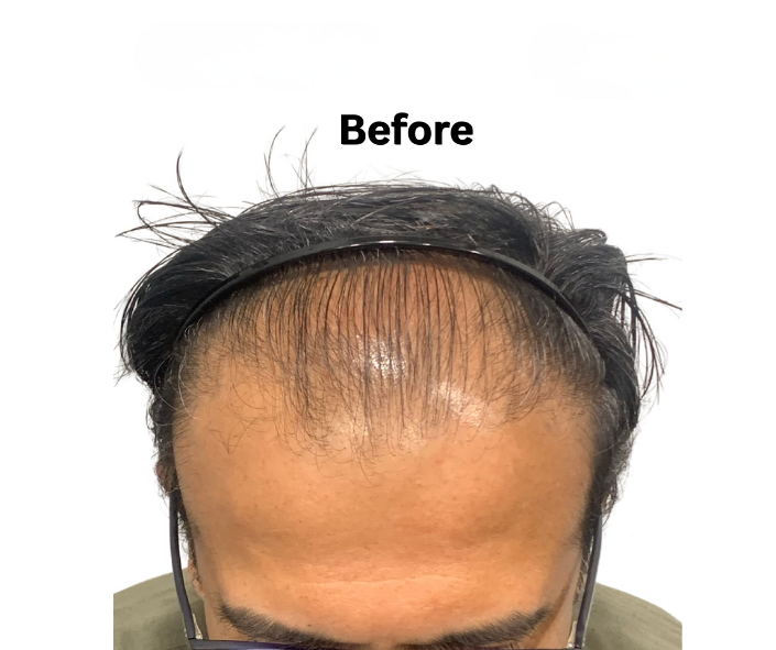Natural hairline design result