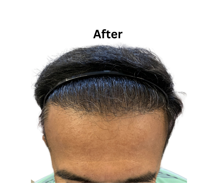 Natural hairline design result