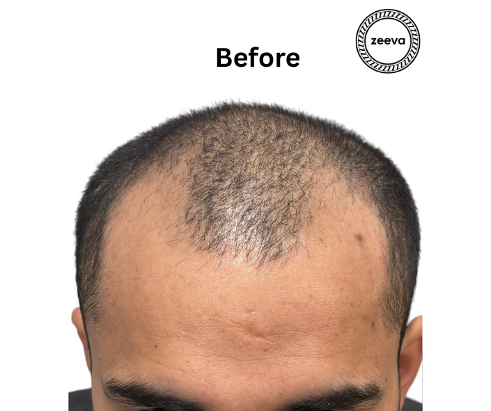 Natural hairline design result