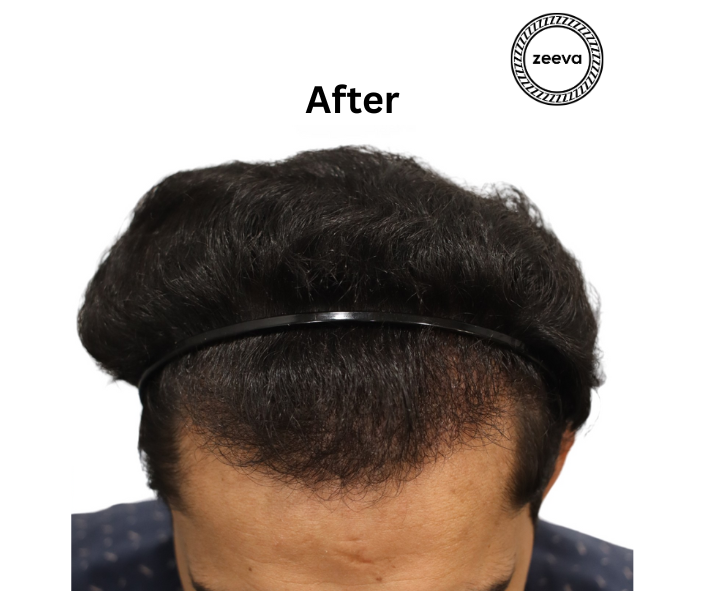 Natural hairline design result