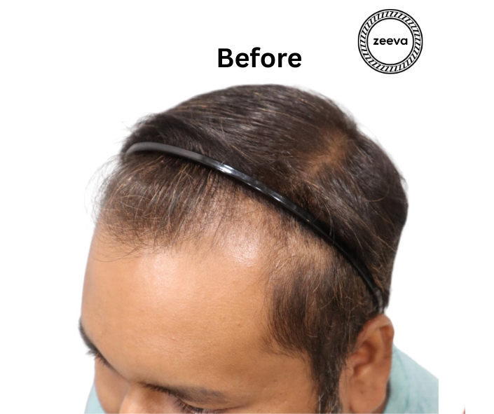 Natural hairline design result