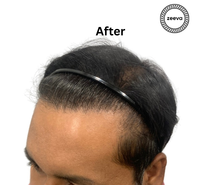 Natural hairline design result