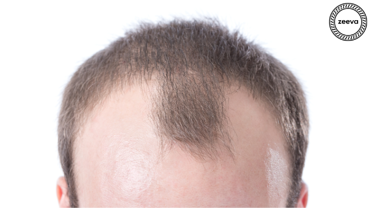 Natural hairline restoration result