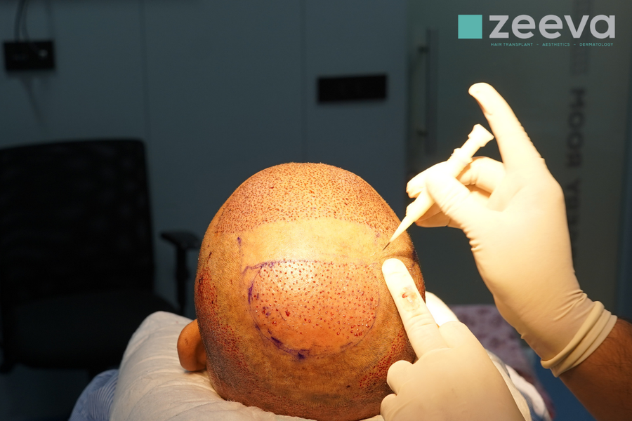 Crown Hair Transplant hero