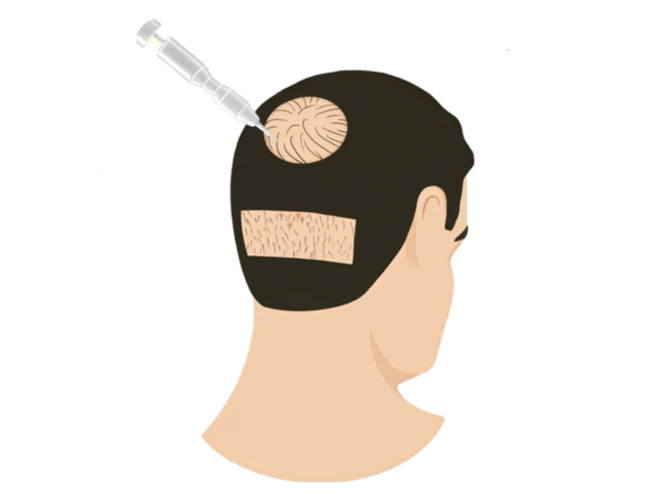 Crown Hair Transplant illustration