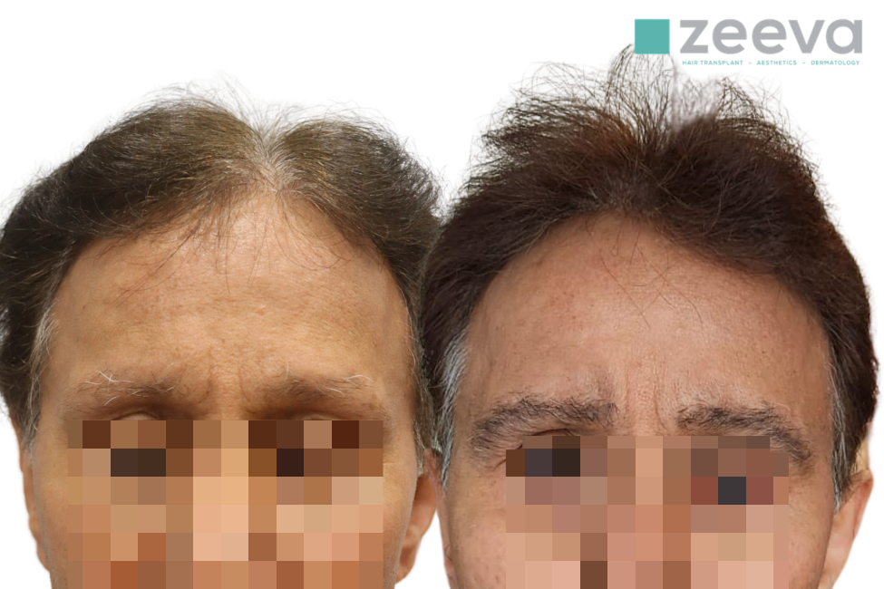 Eyebrow Transplant hero