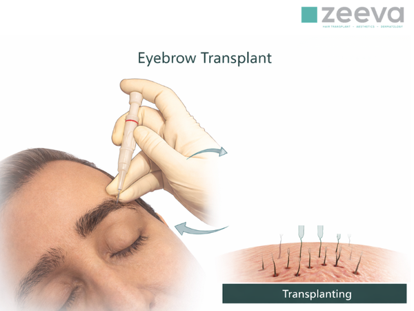 Eyebrow Transplant illustration