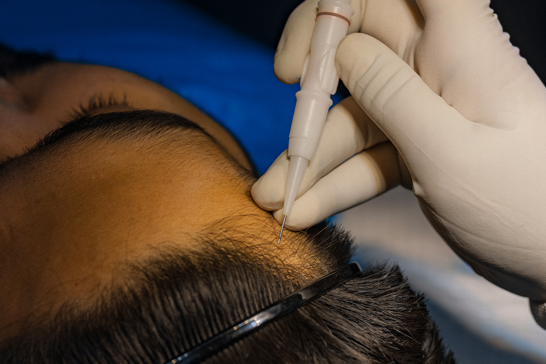 Hair transplant overview hero