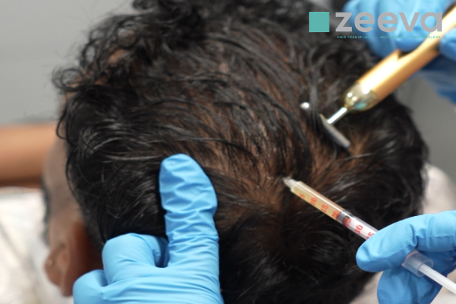 PRP Therapy